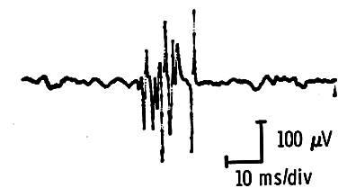 「Fasciculation　emg」の画像検索結果